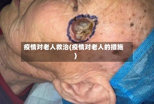 疫情对老人救治(疫情对老人的措施)-第2张图片